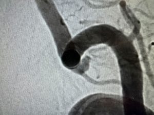 flow diverter stent